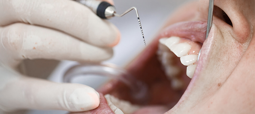 Кюретаж в стоматологии- понятие, показания и особенности