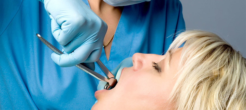 Удаление зуба, ретинированного, дистопированного или сверхкомплектного зуба