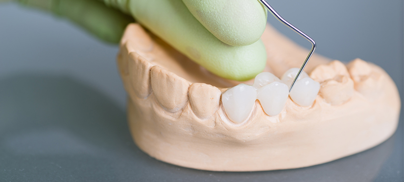 Зубные коронки- металлокерамические или керамические. Что выбрать?