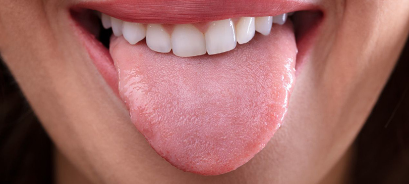 Воспаление языка (глоссит)