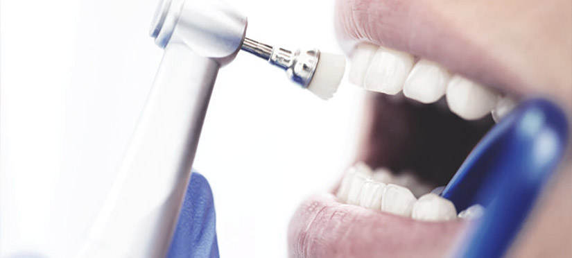Что нужно знать о зубном налете