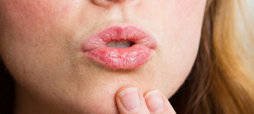Чем опасна хроническая трещина губы
