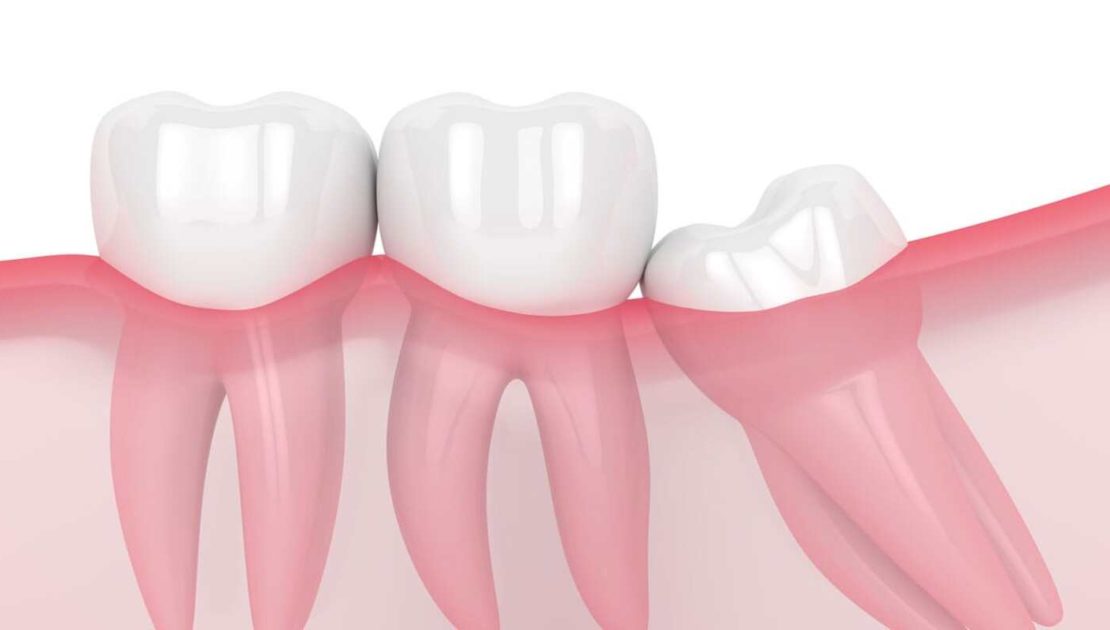 Особенности роста и лечения зубов мудрости