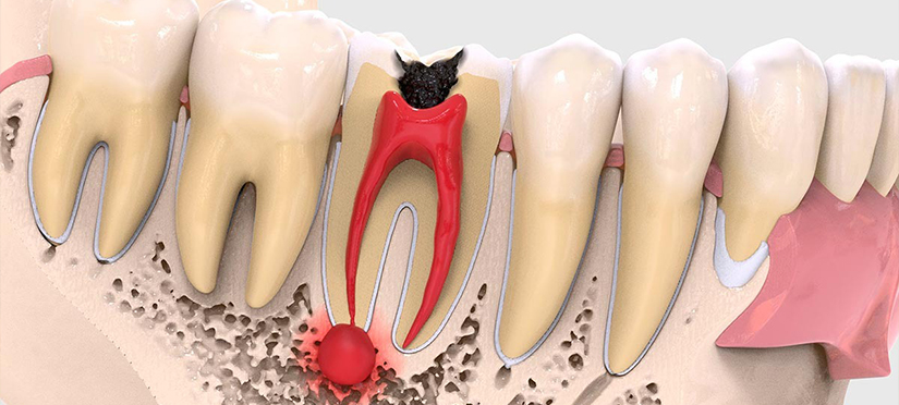Киста зуба - симптомы и лечение кистозного образования