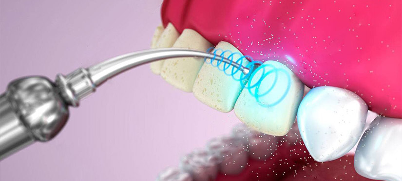 Удаление зубного камня ультразвуком