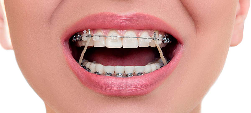 Выравнивание зубов для чего это необходимо и способы выравнивания