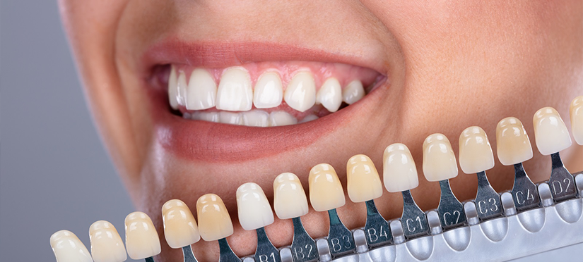 10 мифов об отбеливании зубов