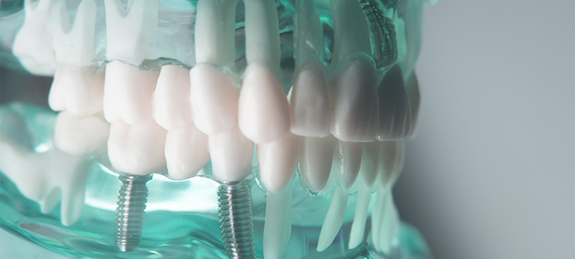 7 преимуществ зубных имплантатов