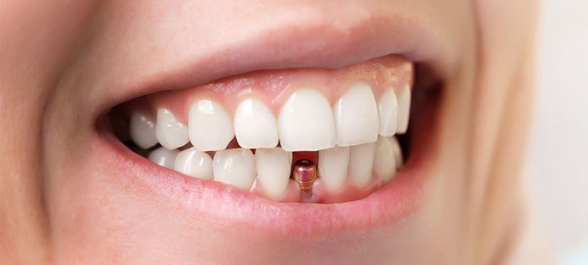 Можно ли получить имплантат переднего зуба