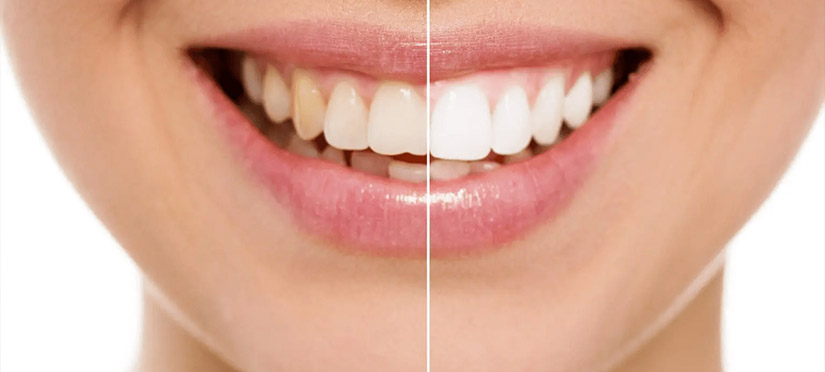 Методы отбеливания зубов в стоматологии и их особенности