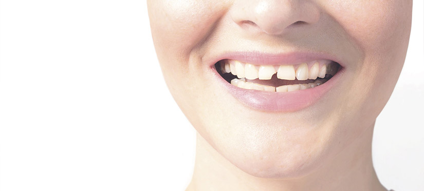Восстанавливаем зуб, если от него откололся кусочек
